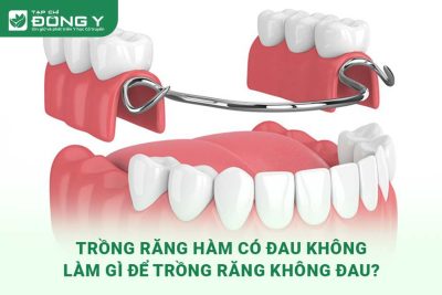 trong-rang-ham-co-dau-khong