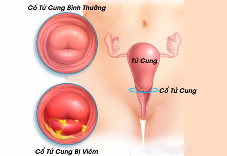 viem co tu cung man tinh