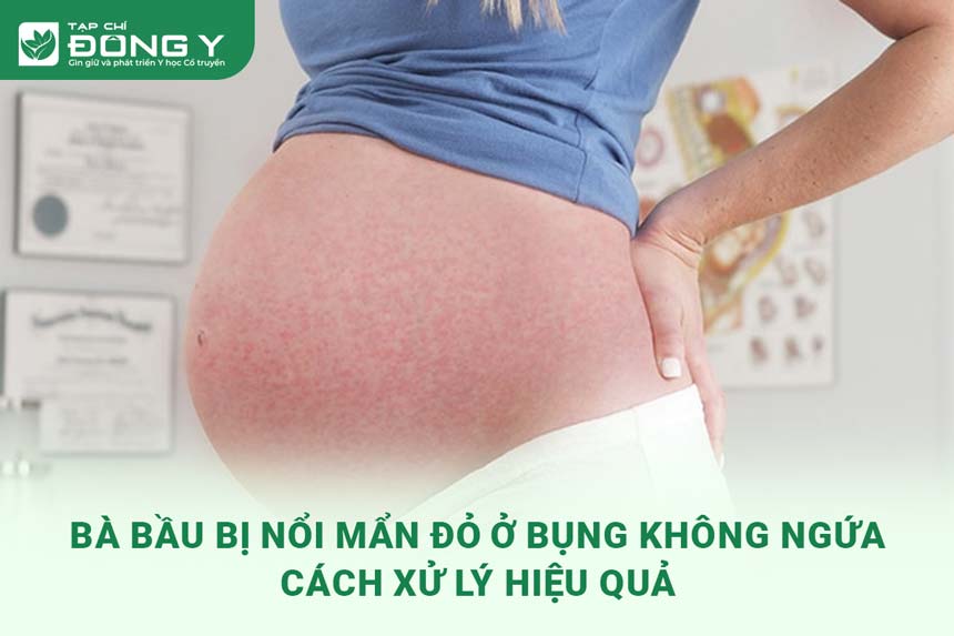 Bụng nổi mẩn đỏ không ngứa: Nguyên nhân, triệu chứng và cách điều trị hiệu quả