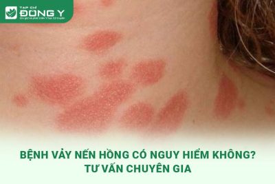 benh-vay-nen-phan-hong-co-nguy-hiem-khong