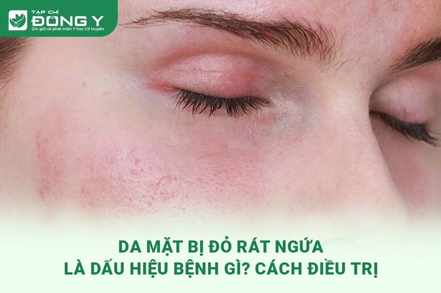 Da Mặt Bị Ngứa Rát: Nguyên Nhân, Triệu Chứng và Giải Pháp Hiệu Quả