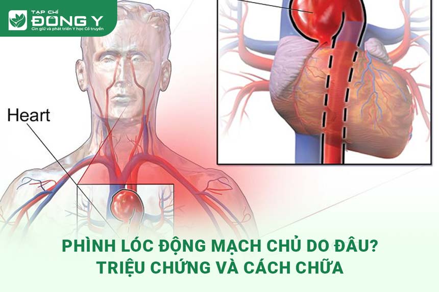 phinh-loc-dong-mach-chu