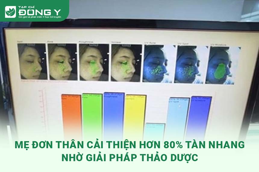 me-don-than-cai-thien-tan-nhang-nho-giai-phap-tu-thao-duoc