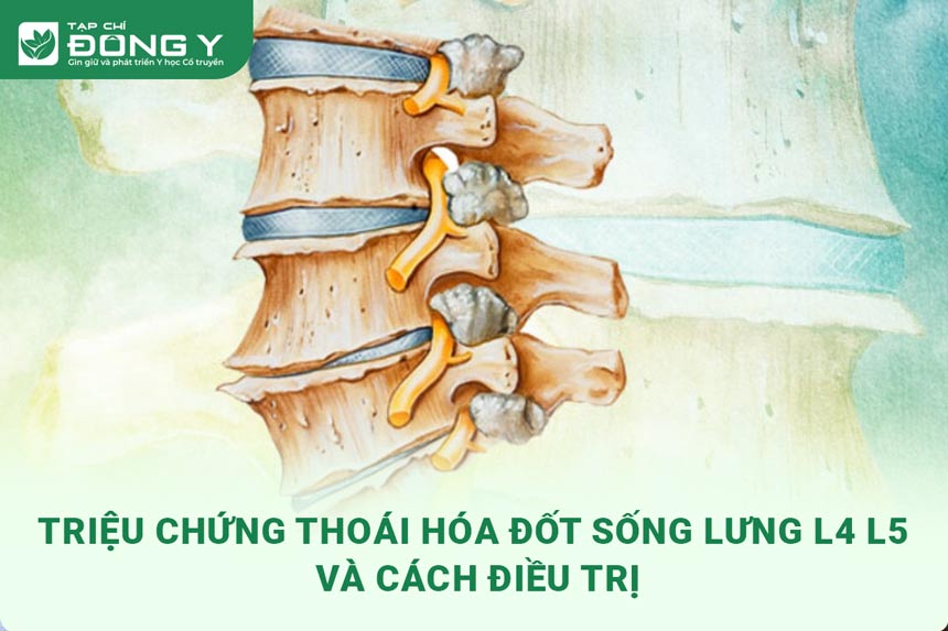 thoai-hoa-dot-song-lung-l4-l5