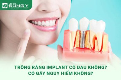 trong-rang-implant-co-dau-khong