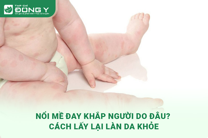 Nổi Mề Đay Khắp Người Do Đâu? Cách Lấy Lại Làn Da Khỏe