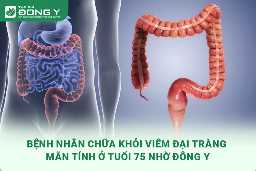 hinh-anh-benh-nhan-chua-khoi-viem-dai-trang-man-tinh-o-tuoi-75-1