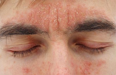 Viêm da dầu có thể nhiễm trùng gây nguy hiểm nếu không điều trị kịp thời