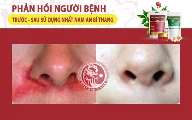 Bệnh nhân phản hồi tích cực sau khi dùng Nhất Nam An Bì Thang