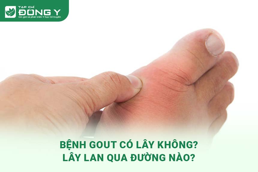 Bệnh Gút Lây Qua Đường Nào? Giải Đáp Từ A Đến Z