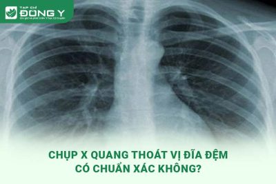 chup-x-quang-thoat-vi-dia-dem