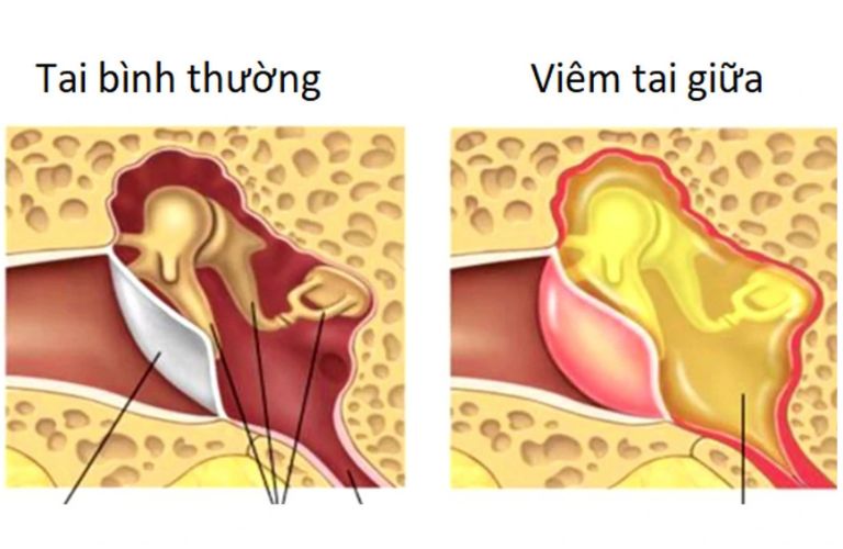 viem-tai-giua-cap-o-nguoi-lon