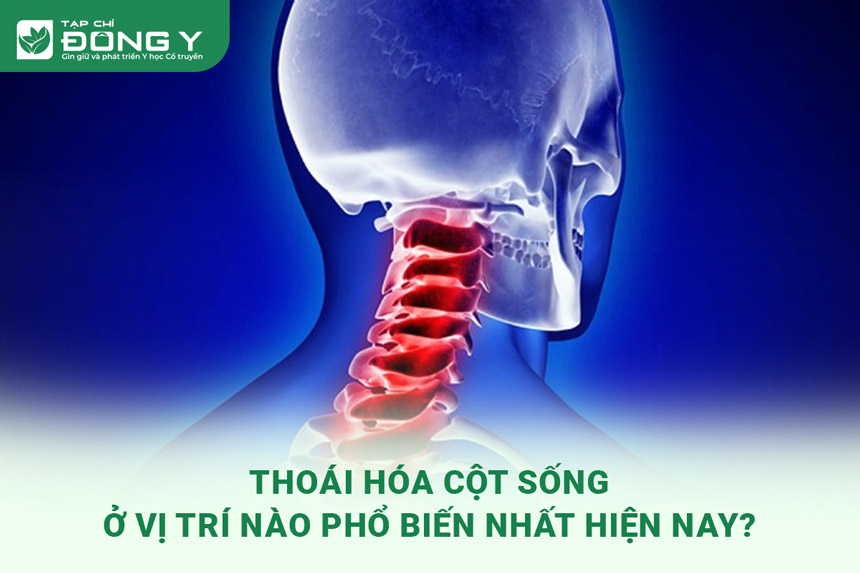 thoai-hoa-cot-song-o-vi-tri-nao-pho-bien-nhat-hien-nay