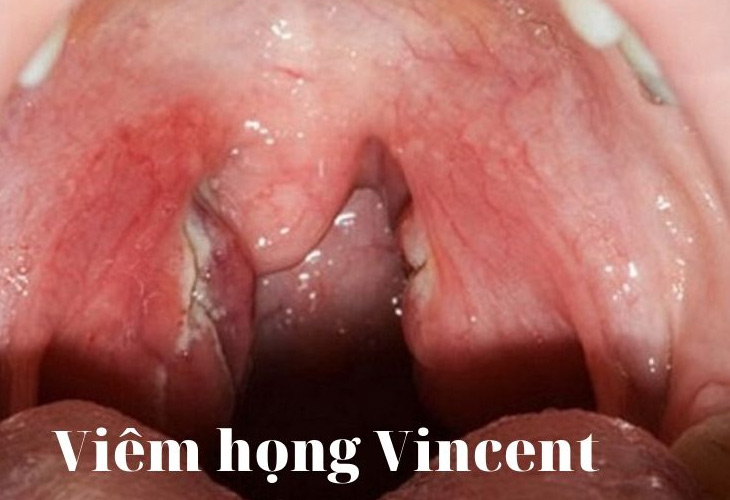 viem-hong-vincent