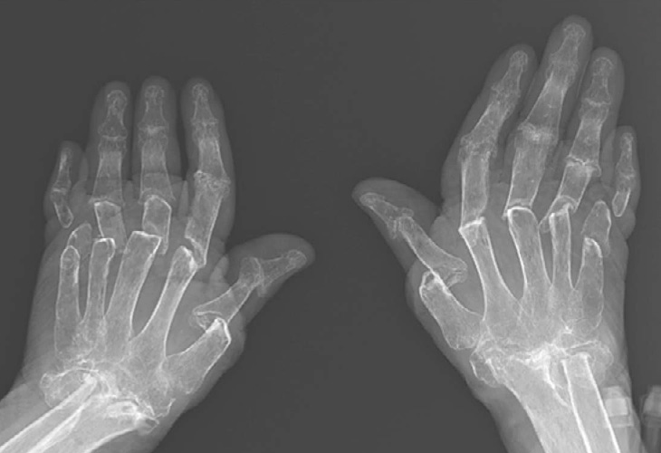 Chụp X-quang giúp nhận biết và quan sát được tình trạng xương khớp