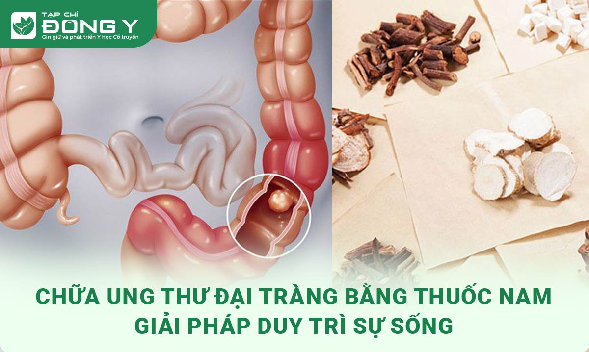 chua-ung-thu-dai-trang-bang-thuoc-nam