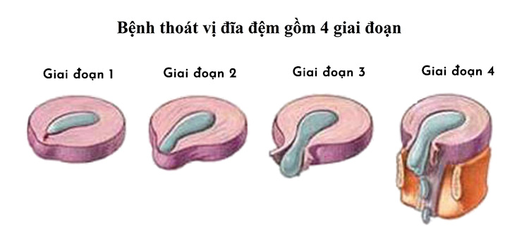 Có 4 giai đoạn thoát vị đĩa đệm, giai đoạn đầu có thể trị khỏi 100% không cần xâm lấn