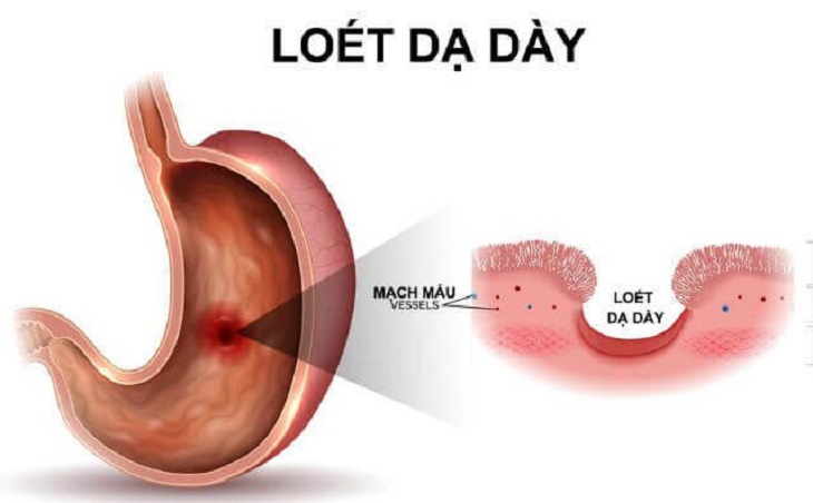 Bệnh đau dạ dày có thể chữa mẹo tại nhà nếu như phát hiện sớm