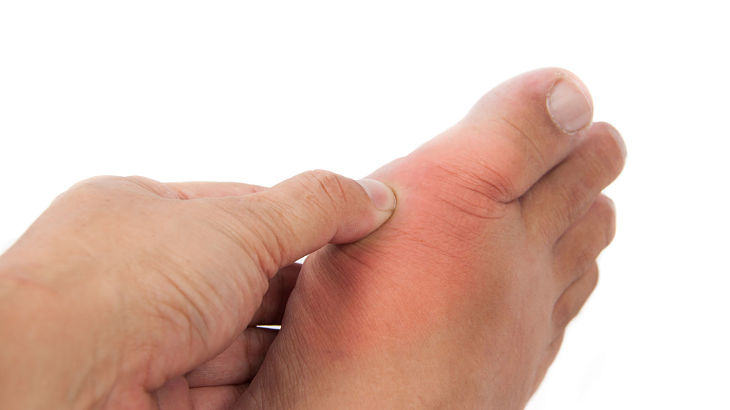 Bệnh gout không lây nhiễm từ người này sang người khác