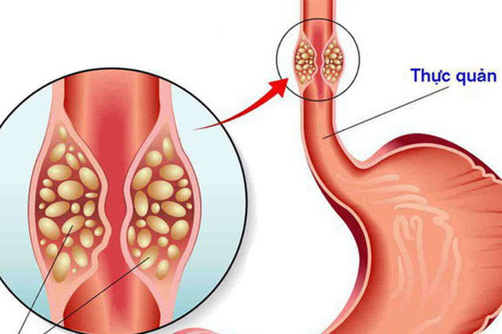 Bệnh Trào Ngược Dạ Dày Thực Quản K21: Triệu Chứng, Nguyên Nhân Và Cách Điều Trị Hiệu Quả