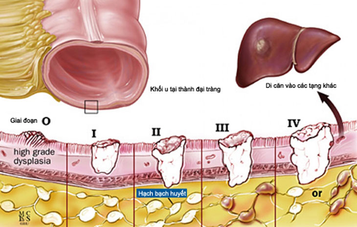 Xác định chính xác các giai đoạn của ung thư đại tràng hỗ trợ điều trị bệnh hiệu quả