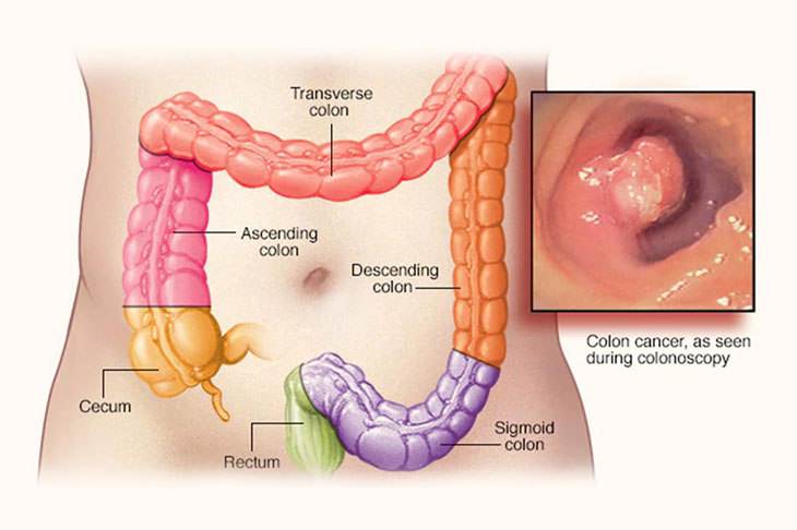 Điều trị ung thư giai đoạn đầu tỷ lệ thành công cao