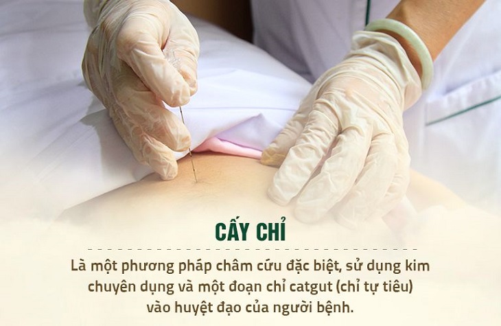 Cấy chỉ là phương pháp trị liệu được kết hợp giữa YHCT và Y học hiện đại