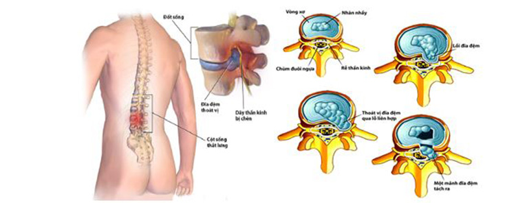 Điều trị thoát vị đĩa đệm bằng sóng cao tần giúp thu nhỏ nhân nhầy, đưa đĩa đệm về vị trí ban đầu.