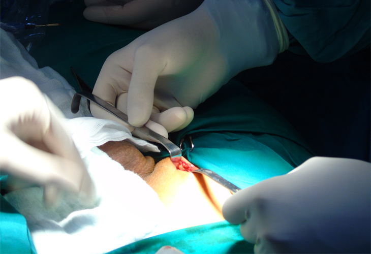 Phẫu thuật được chỉ định khi nam giới mắc chứng giãn tĩnh mạch thừng tinh