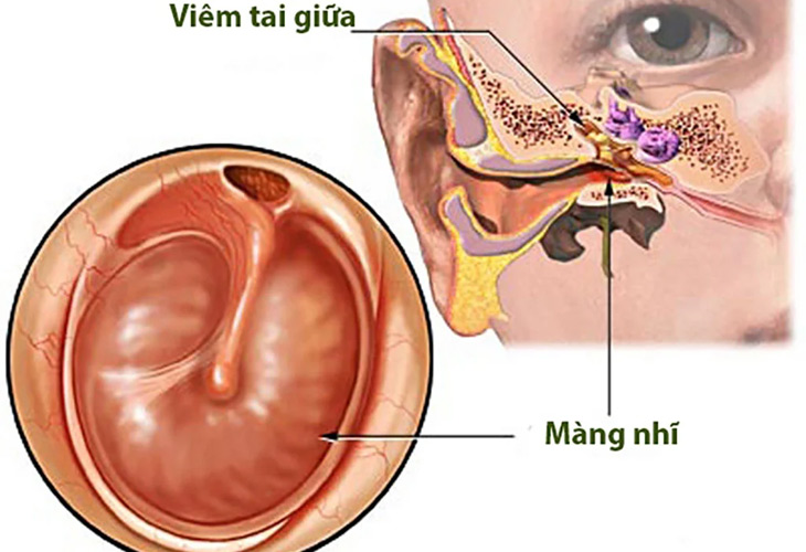 Thủng màng nhĩ là một trong những biến chứng nguy hiểm của bệnh