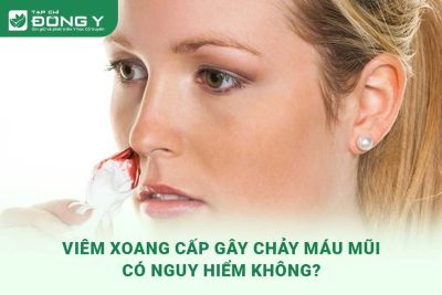 viem-xoang-cap-gay-chay-mau-mui