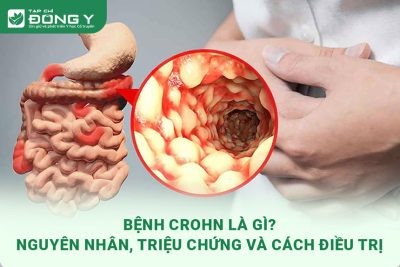 benh-crohn