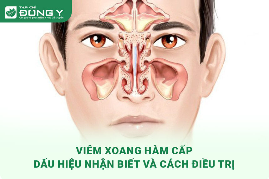 viem xoang ham cap