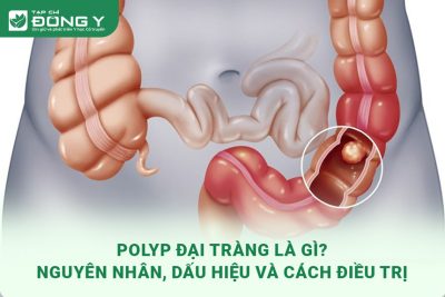 polyp-dai-trang