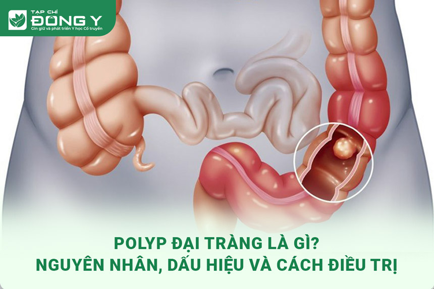 polyp-dai-trang