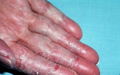 Những vết bong tróc xuất hiện ở bàn tay do viêm da cơ địa á sừng