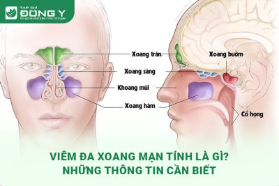 viem-da-xoang-man-tinh-la-gi