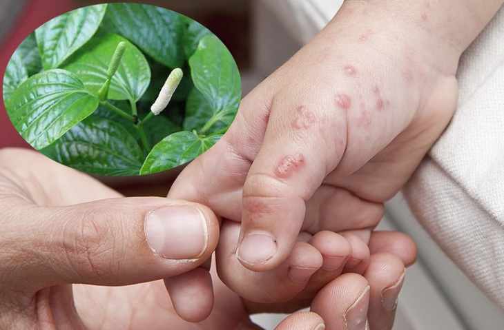 Vì đâu lá lốt có khả năng chữa bệnh viêm da cơ địa