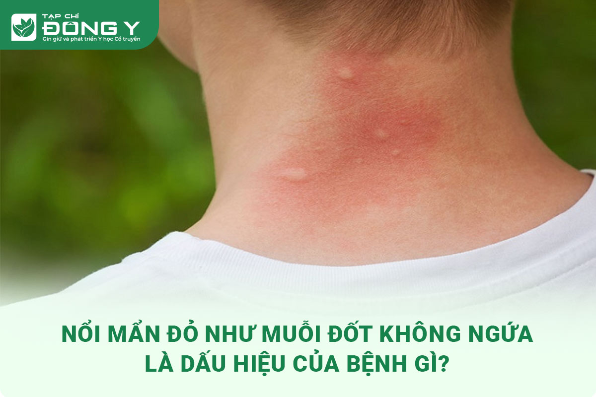 Nổi Mẩn Đỏ Như Muỗi Đốt Không Ngứa: Nguyên Nhân, Cách Điều Trị Và Phòng Ngừa Hiệu Quả