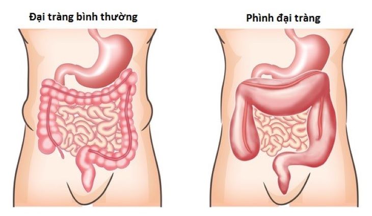 Phình đại tràng là hiện tượng đại tràng bị giãn nở bất thường