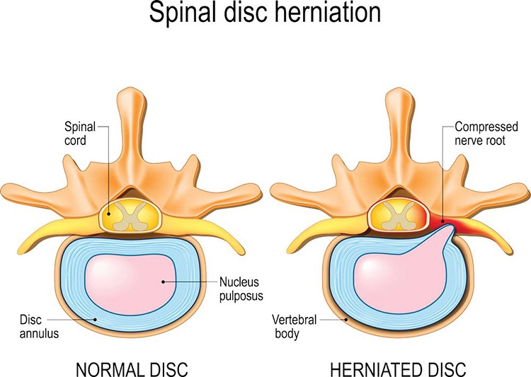 Thoát vị đĩa đệm trong tiếng Anh được gọi là Herniated Disc (hay Slipped Disc)