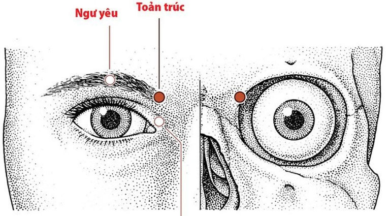 huyệt toản trúc chữa viêm xoang bướm