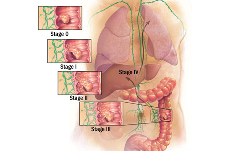 Ung thư đại tràng di căn đến nhiều cơ quan khác nhau