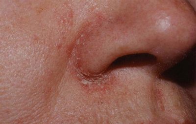 Vảy nến ở mũi là bệnh gì? Có đáng sợ không?