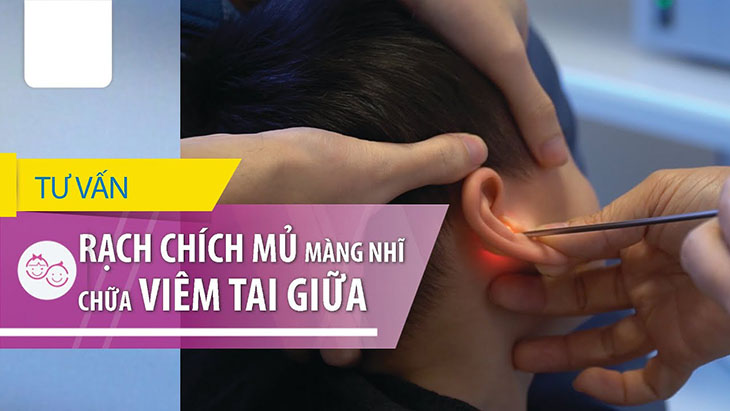 Viêm tai giữa có nên chích mủ không? - Nên lắng nghe những tư vấn từ bác sĩ chuyên khoa