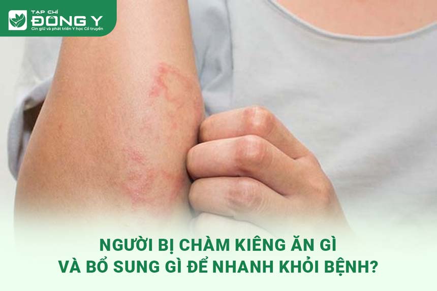 7. Kết Luận: Tầm Quan Trọng Của Chế Độ Ăn Uống Trong Việc Điều Trị Bệnh Chàm