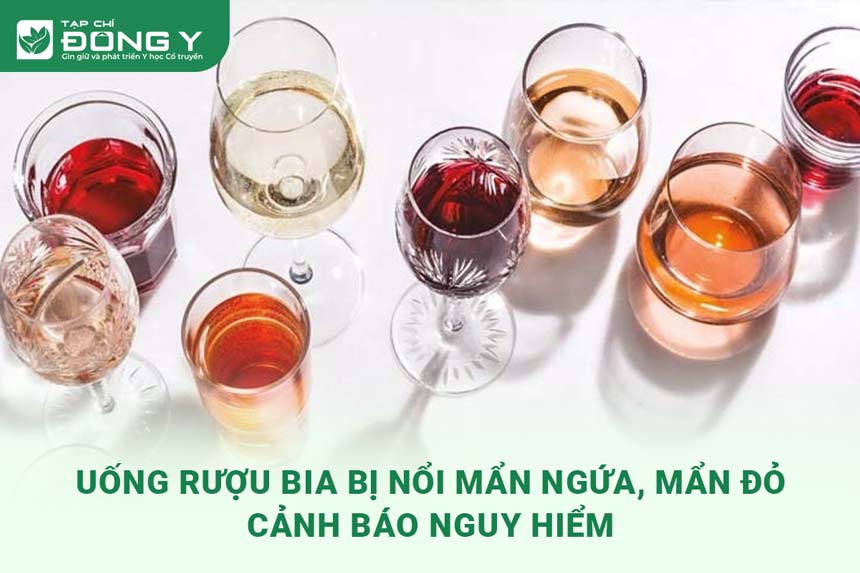 Sau khi uống rượu bia bị nổi mẩn ngứa: Nguyên nhân và cách xử lý hiệu quả