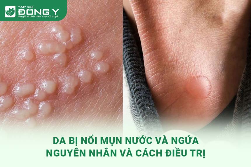 Phòng ngừa và cách điều trị