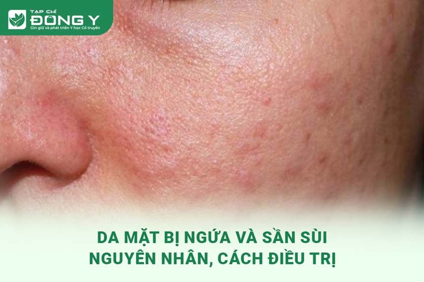 5. Lời Khuyên Để Ngăn Ngừa Ngứa Da Mặt