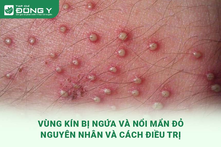 3. Cách Điều Trị Ngứa và Nổi Mẩn Đỏ Ở Vùng Kín